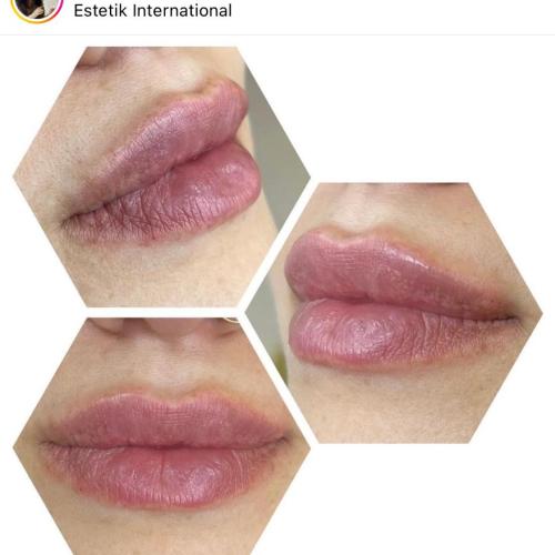 Botox Before / After photo